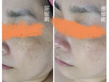 シミの徹底ケア&たるみシワ改善でハリのある美肌へ