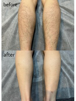 ヴィシアス(VIXIAS)/脱毛　施術1回　約2ヶ月後