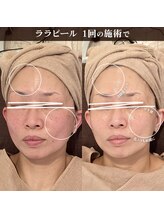 キノセ(kinose)/ララピール正規導入店