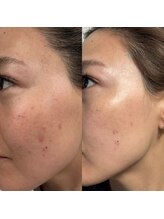 ダリア(Dahlia)/スキンケアのみの変化★