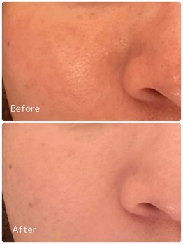 ククル(KUKULU)/陶肌トリートメント4回目♪