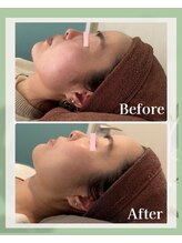 レトラ鍼灸院/ハーブピーリング