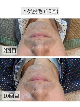 アースコアフュールボーテ ひたち野うしく店(EARTH coiffure beaute)/ヒゲ脱毛10回 before→after