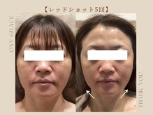 オキシー グレイス 黒崎店(OXY Grace)/レッドショット5回