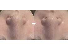 美助(bisuke)/水素ハイドロ毛穴洗浄コース１回