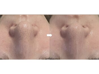 美助(bisuke)/水素ハイドロ毛穴洗浄コース１回