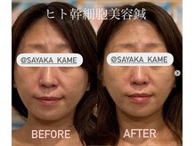 ぶんのいち整体院/美容鍼+人幹細胞でエイジング