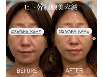 ぶんのいち整体院/美容鍼+人幹細胞でエイジング