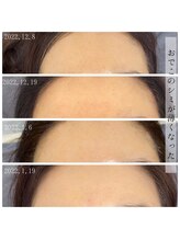 ソワン(Sowan)/マイクロニードルピーリング