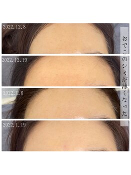 ソワン(Sowan)/マイクロニードルピーリング