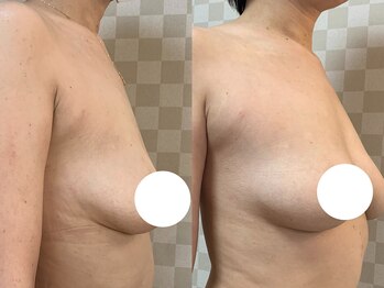 ハレオラ(HaleOla)/お客様の変化☆バストケア