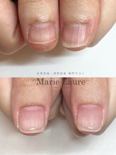 マリーロール 梅田店(Marie Laure)/自爪育成/深爪矯正/ネイルケア