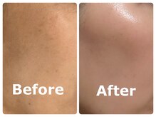 スイ 昭島店(Sui)/ハーブピーリング/シミケア/美白