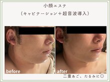 べセラ(BESERA)/小顔エステ 2