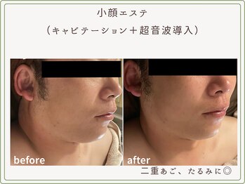 べセラ(BESERA)/小顔エステ 2