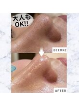 リミー(Reme)/大人もOK♪ハイドロ洗浄☆彡