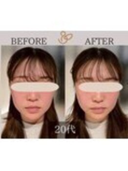 チョコバリ 錦糸町店(chocobari)/小顔×リフトアップ(美容鍼)20代