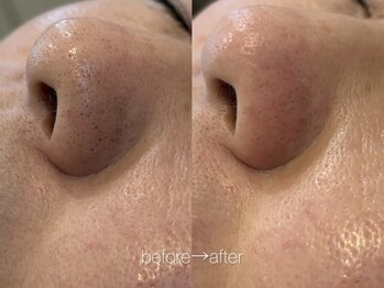 リコ ヘアアンドリラクゼーション(LICO)/フェイスワックス