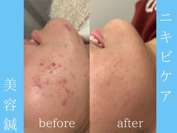 ビープラス(BEE PLUS)/ニキビケア