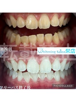 ホワイトニングサロン 名古屋 栄店/【ホワイトニング】