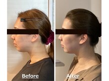 小顔22 ボルティ 赤坂支店(Bolty)/小顔シンメトリー矯正＆全身矯正