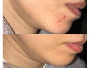 ル シーニュ/プロセル×1回