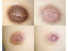 ライム 新宿西口(LIME)/ローマピンク｜黒ずみケア