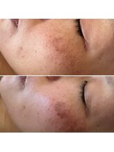 ナチュラ 諫早店(NAchuRA)/シミケア