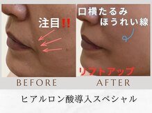 トータルビューティー マインド(Total Beauty)/《ヒアルロン酸導入セラピー》