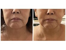 ナユラスパ(Nayula Spa)/脂肪分解レモンボトル