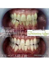 ホワイトニングサロン 広島店/【ホワイトニング施術例】