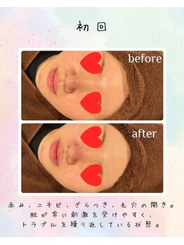 リリアン(lirien)/毛穴/毛穴ケア/毛穴洗浄/駒込