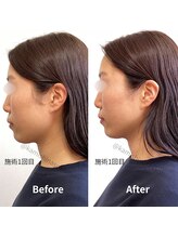 かみしな接骨院/モニター1回目の施術結果