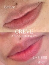 クレーヴ(CREVE)/モニター様経過写真【2ヶ月】