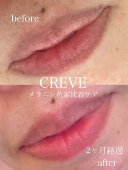 クレーヴ(CREVE)/モニター様経過写真【2ヶ月】