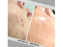 スムース イー(Smooth+E)の雰囲気（高槻で本気の毛穴　ニキビケア　年齢肌改善なら当店へ。）