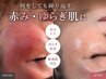 【何をしても繰り返す肌荒れに】赤み・ゆらぎ肌卒業ケア¥14800→11000