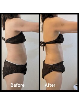 アリビオ(ALIVIO)/1ヶ月集中モニター