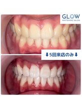 グロウ 銀座店(GLOW)/最短1ヶ月で白い歯に☆
