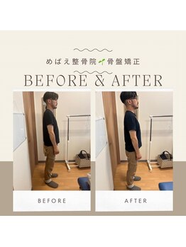 めばえ整骨院/姿勢のbefore after