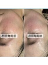 ル ボヌール 伊那店(le bonheur)/シミケア3回目※シミ垢化は2回