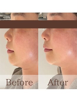 凪眠/小顔リンパフェイシャルの効果73