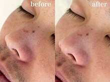 ビエント(VIENTO)/モテたい人はやってる毛穴ケア☆