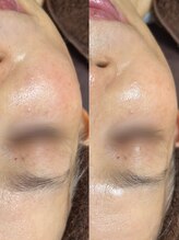 ソレラ(sorelle)/ソフトダーマ