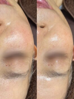 ソレラ(sorelle)/ソフトダーマ