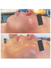 ジャスミン(Jasmin)/プラペン×幹細胞