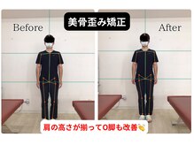 べっぷ餅ヶ浜整体院/美骨歪み矯正before/after