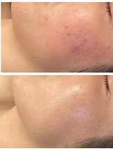 バース(Birth...)&nbsp;赤み改善も お任せ