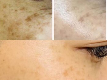 サロン ド ヒノキ(Salon de HINOKI)/シミ改善！美白ケアフェイシャル