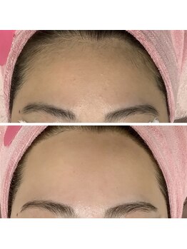 ルル(RuRu)/ Wax脱毛